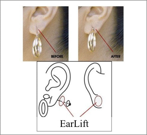 Original EARLIFT USA "Invisible Ear Lobe Support Waterproof Medical Patches"